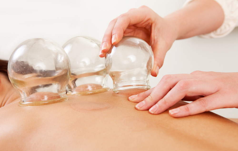 cupping therapy